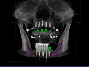 Guided Dental Implant Surgery