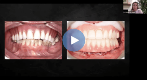 Complete Dentures Pearls for Preditablity Dental CE Webinar